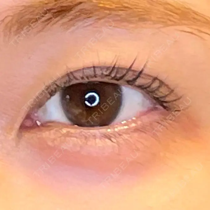 目尻切開 / 口角挙上 / タレ目形成・グラマラスライン（埋没） LOUIS CLINIC 二子玉川院【ルイクリニック】 BEFORE メイン用