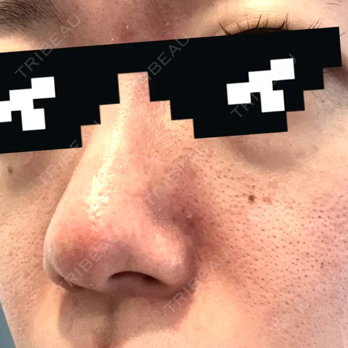 肌育注射（ジュベルックなど） / その他（肌） ゆきスキンクリニック 東池袋 BEFORE メイン用