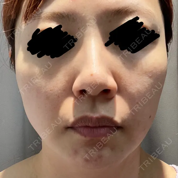 医療痩身（顔） NEO Skin Clinic恵比寿 BEFORE メイン用