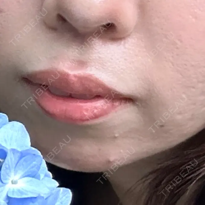 ヒアルロン酸注入（涙袋） / ヒアルロン酸注入（唇） 共立美容外科 熊本院 BEFORE メイン用