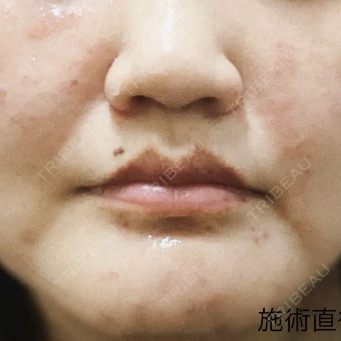 ピコレーザートーニング（美白・肝斑） 東京シルククリニック 東京神田院 BEFORE メイン用