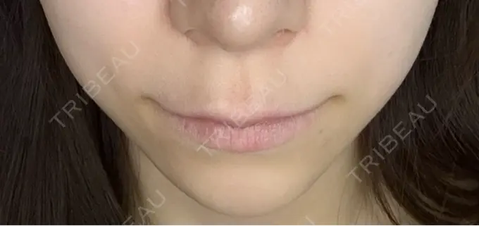 人中短縮 / 口角挙上 / その他（口元） R Beauty CLINIC 銀座院 BEFORE メイン用