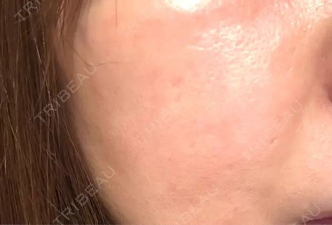 肌育注射（ジュベルックなど） / リジュラン 城本クリニック 新宿院 BEFORE メイン用