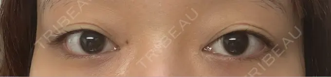 二重埋没 Stand by Beauty Clinic BEFORE メイン用