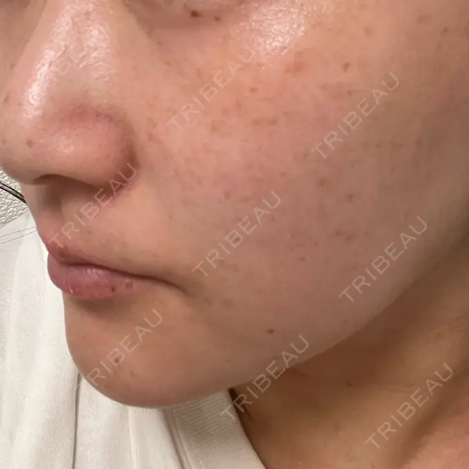 ルビーレーザー Designo Clinic （デジーノクリニック） BEFORE メイン用