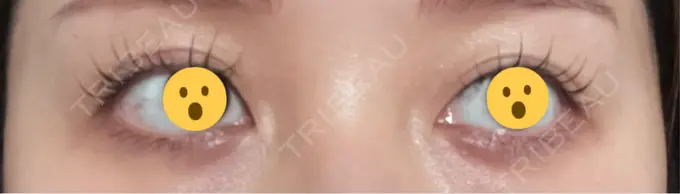 ヒアルロン酸注入（涙袋） AI Beauty Clinic （エーアイ美容クリニック） BEFORE メイン用