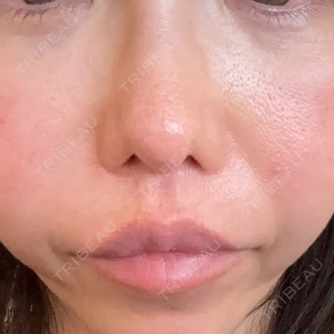 リジュラン しんゆり美容健康クリニック BEFORE メイン用