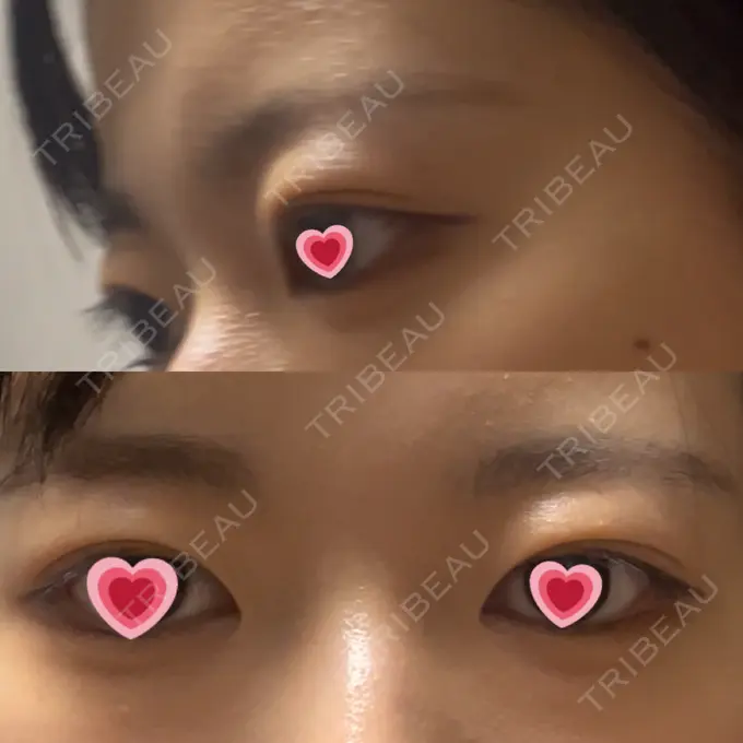 眉下切開 PRO CLINIC プロクリニック 銀座院 BEFORE メイン用