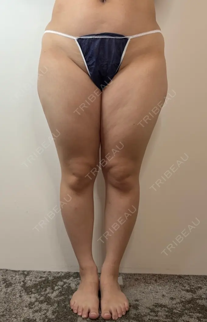 脂肪吸引（顔） / 脂肪吸引（脚） / 脂肪吸引（お尻） GAYA body design clinic BEFORE メイン用