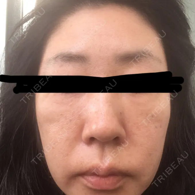 再生医療 RDクリニック大阪 BEFORE メイン用