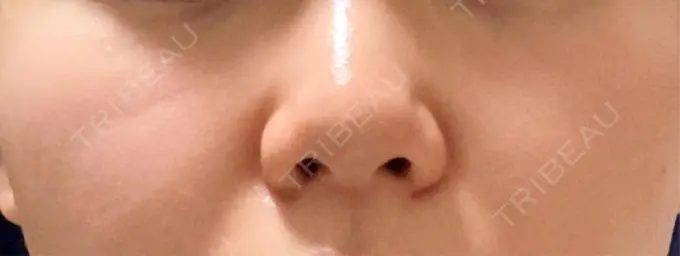 ヒアルロン酸注入（鼻） / ヒアルロン酸注入（頬） オアシス美容外科 BEFORE メイン用