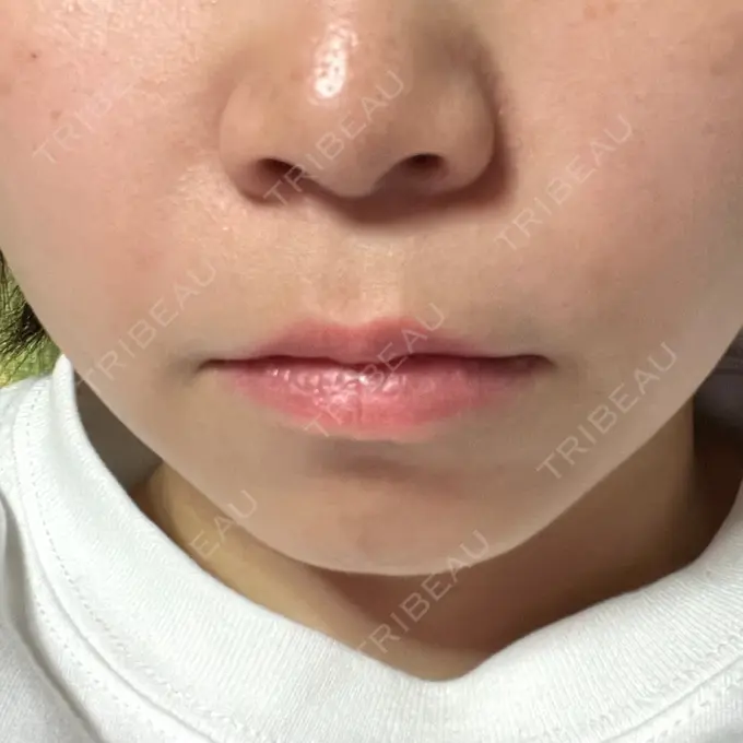 ボトックス（口角） / ボトックス（ガミースマイル） ルラ美容クリニック 渋谷本院 BEFORE メイン用