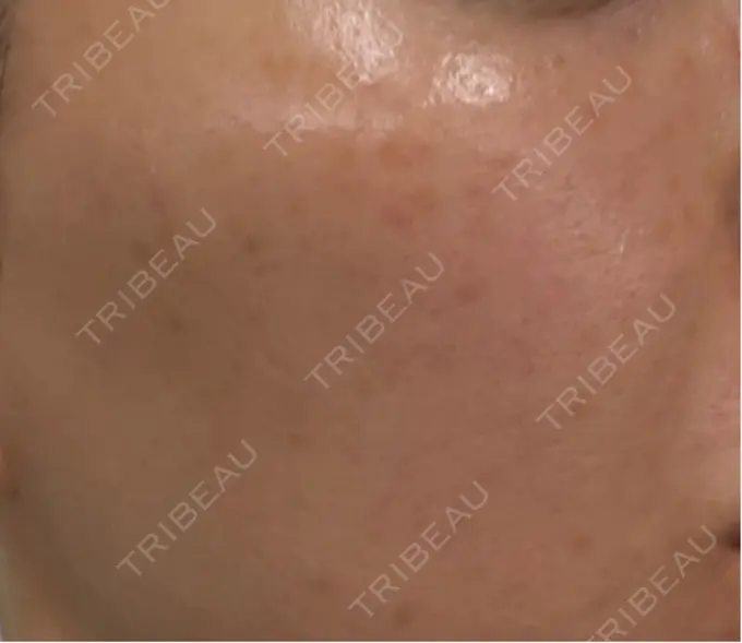 イオン導入 / ピーリング（ハリ・ツヤ） / ルメッカ ルラ美容クリニック 名古屋栄院 / ルラスキンクリニック 名古屋栄院 BEFORE メイン用