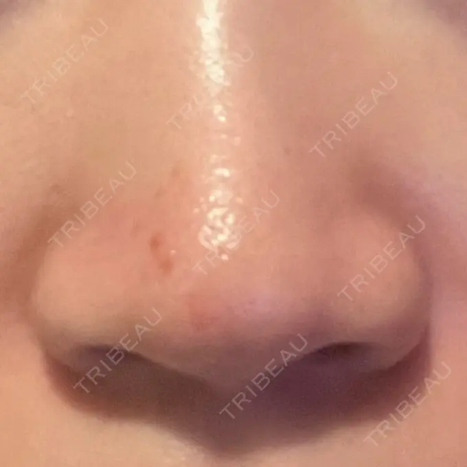 アグネス KM新宿クリニック BEFORE メイン用