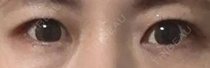 ヒアルロン酸注入（涙袋） 小倉美容外科/美容皮膚科 ビラビューティークリニック BEFORE メイン用