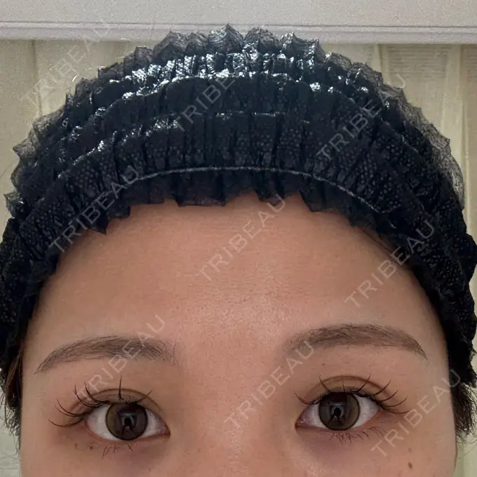 ヒアルロン酸注入（涙袋） AZ BEAUTY CLINIC BEFORE メイン用