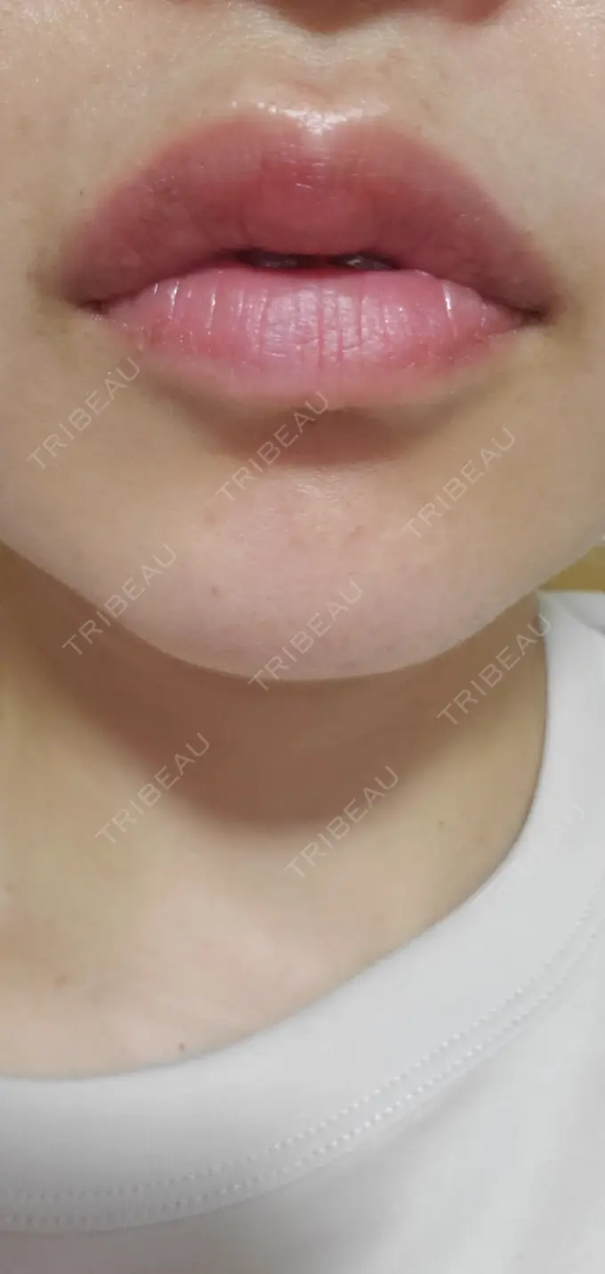 ヒアルロン酸注入（あご） / シワ取りボトックス / ボトックス（額） 湘南美容クリニック 浜松院 BEFORE メイン用