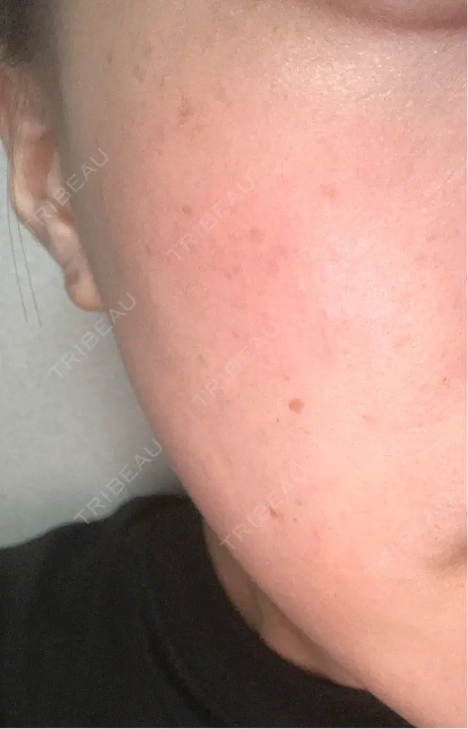 ピーリング（ニキビ・毛穴） ルラ美容クリニック 横浜院 BEFORE メイン用