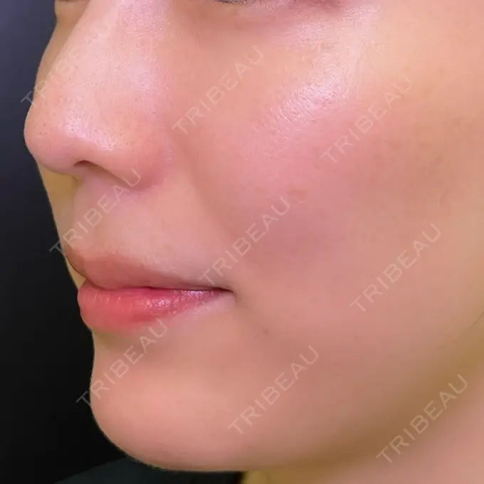 鼻尖形成（切開） eクリニック 富山駅前院 BEFORE メイン用