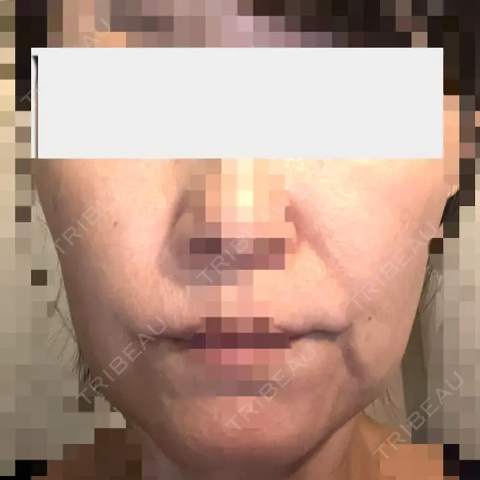 糸リフト / 肌ヒアルロン酸注入（たるみ・シワ改善） gift clinic BEFORE メイン用