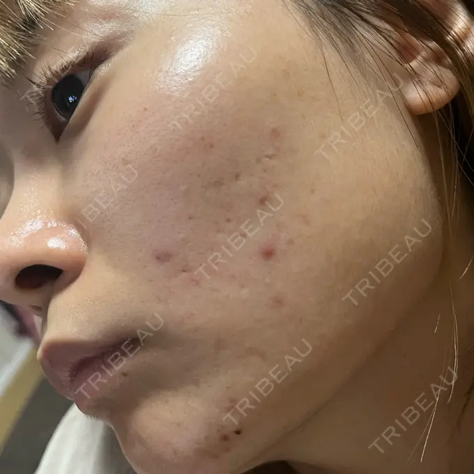 ピコフラクショナルレーザー（毛穴・ニキビ跡） ルラ美容クリニック 大宮院 / ルラスキンクリニック 大宮院 BEFORE メイン用