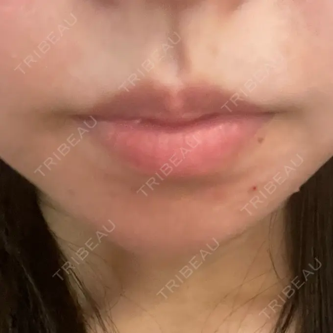 ボトックス（あご） / ボトックス（口角） / シワ取りボトックス LE CLINIC BEFORE メイン用