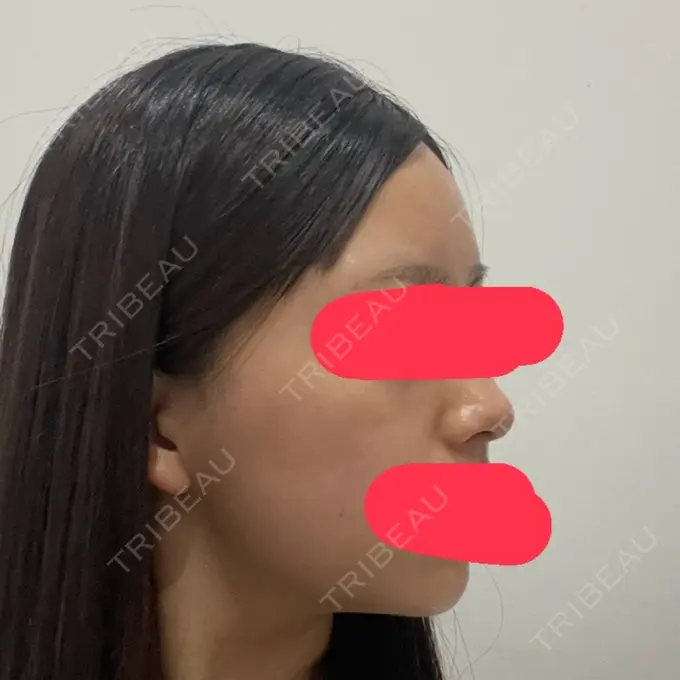 その他（輪郭） ルラ美容クリニック 渋谷本院 BEFORE メイン用