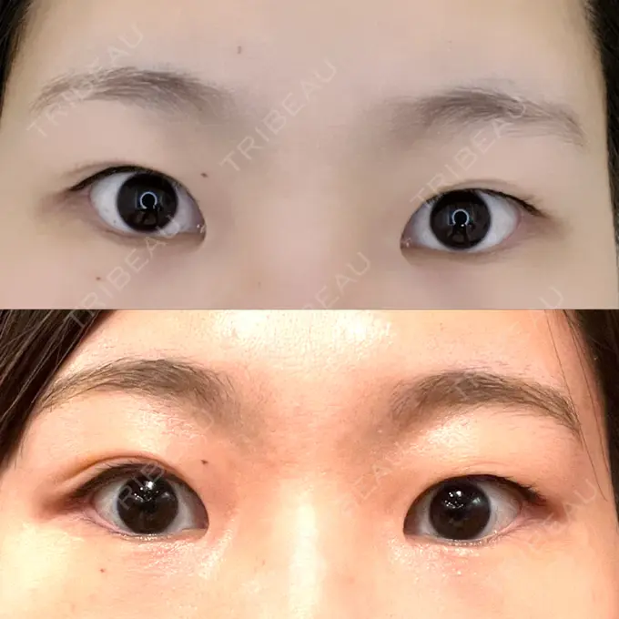 二重埋没 オアシス美容外科 BEFORE メイン用