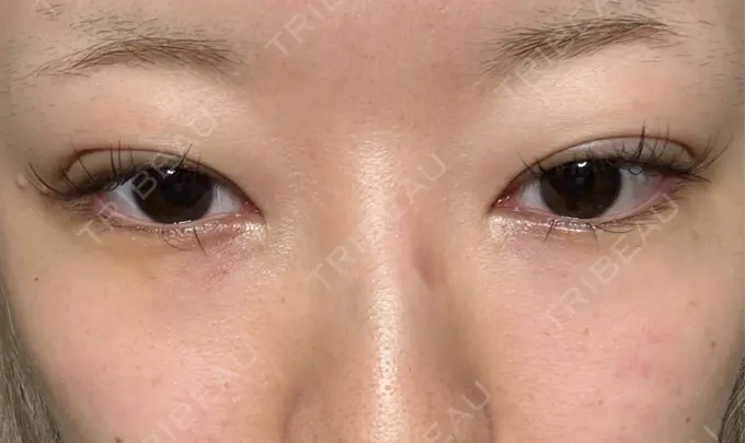 下まぶたの脂肪取り / 眉下切開 東京中央クリニック BEFORE メイン用