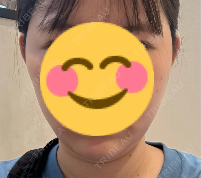 脂肪吸引（顔） / 脂肪吸引注射（顔） ziz CLINIC BEFORE メイン用