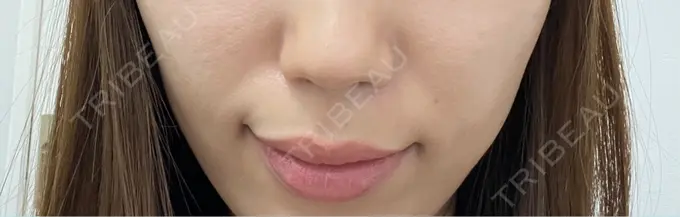 ヒアルロン酸注入（額） / ボトックス（肩） ルラ美容クリニック 大阪本院 BEFORE メイン用