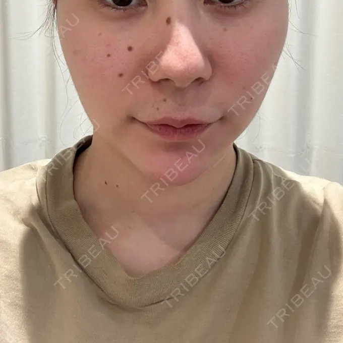 光治療（フォトフェイシャルなど） / RF（高周波）たるみ治療 Wi Clinic（ウィ クリニック） 大宮院 BEFORE メイン用