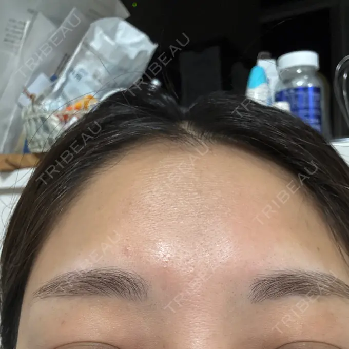 ボトックス（眉間） ルラ美容クリニック 高田馬場院 BEFORE メイン用