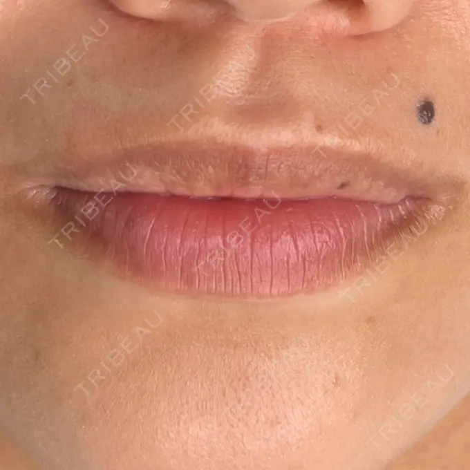 アートメイク（唇） LEAGRANT CLINIC 中目黒 BEFORE メイン用