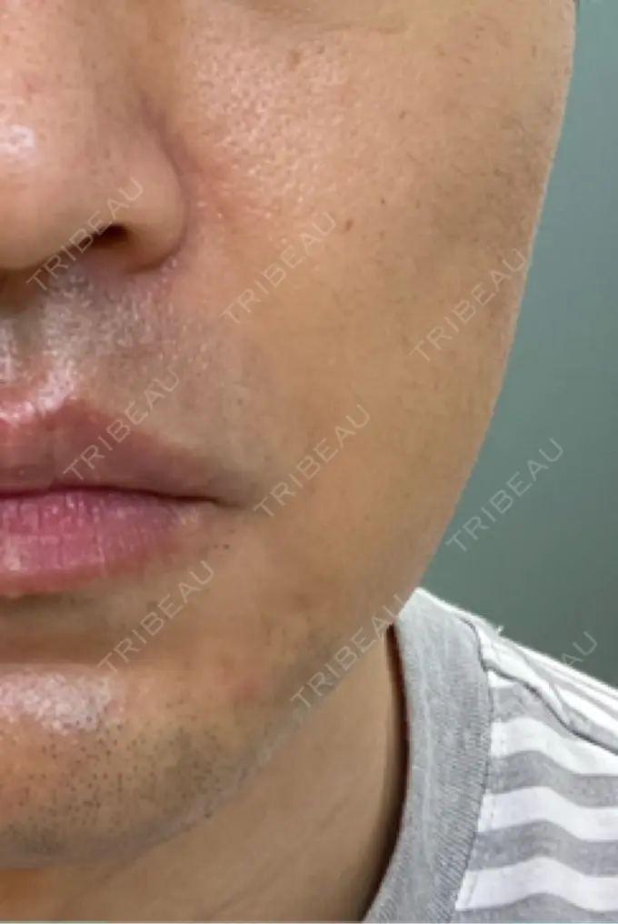 ボトックス（エラ・小顔） 品川スキンクリニック広島院 BEFORE メイン用