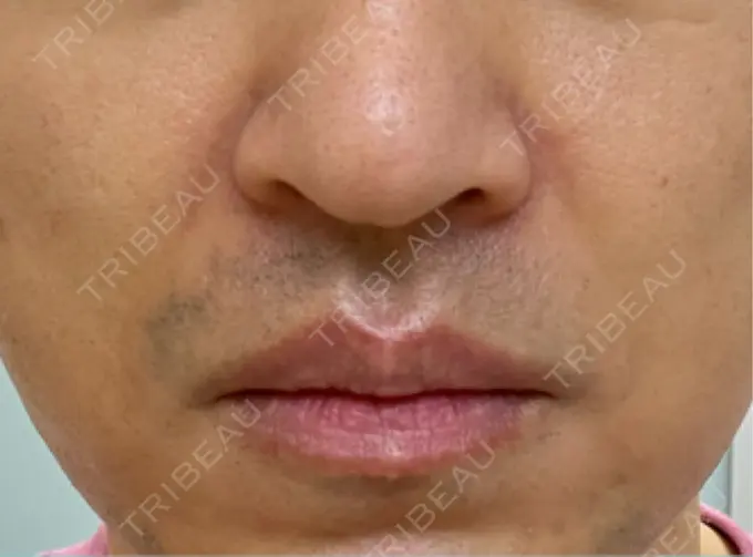 脂肪溶解注射（顔） TCB東京中央美容外科 広島院 BEFORE メイン用