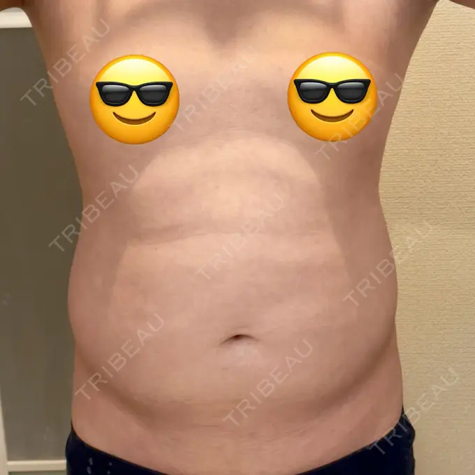 脂肪吸引（お腹） / 脂肪吸引（腰） オアシス美容外科 BEFORE メイン用