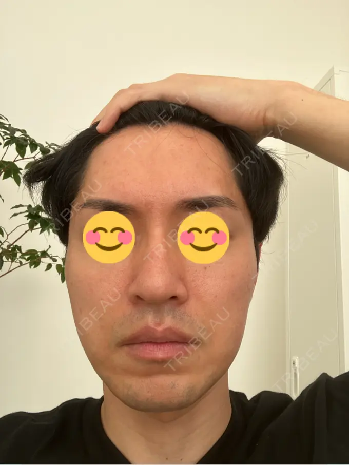 ピコレーザートーニング（美白・肝斑） / フラクショナルレーザー（毛穴・ニキビ跡） ルラ美容クリニック 広島院 BEFORE メイン用