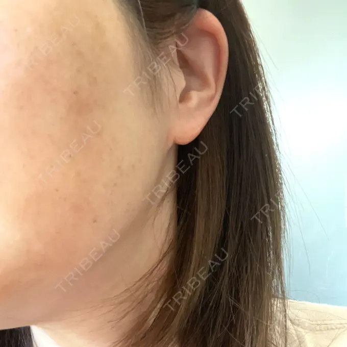 ピコレーザートーニング（美白・肝斑） / ピーリング（ハリ・ツヤ） ルラ美容クリニック 仙台院 / ルラスキンクリニック 仙台院 BEFORE メイン用