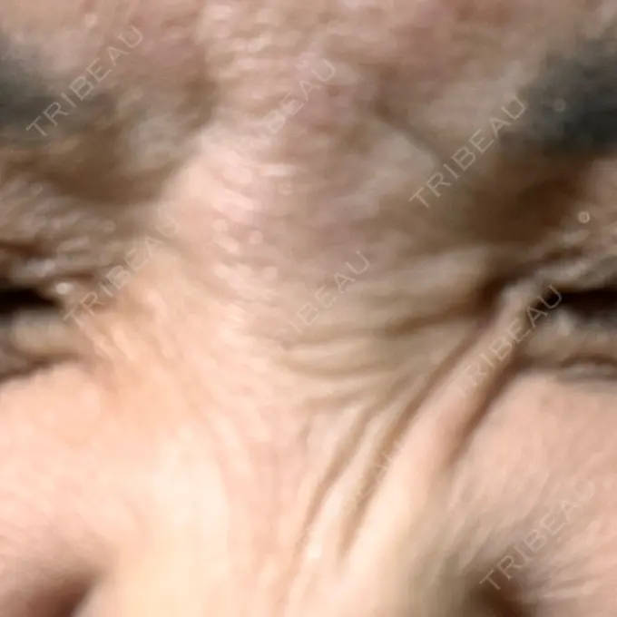 ボトックス（眉間） TCB東京中央美容外科 三島院 BEFORE メイン用