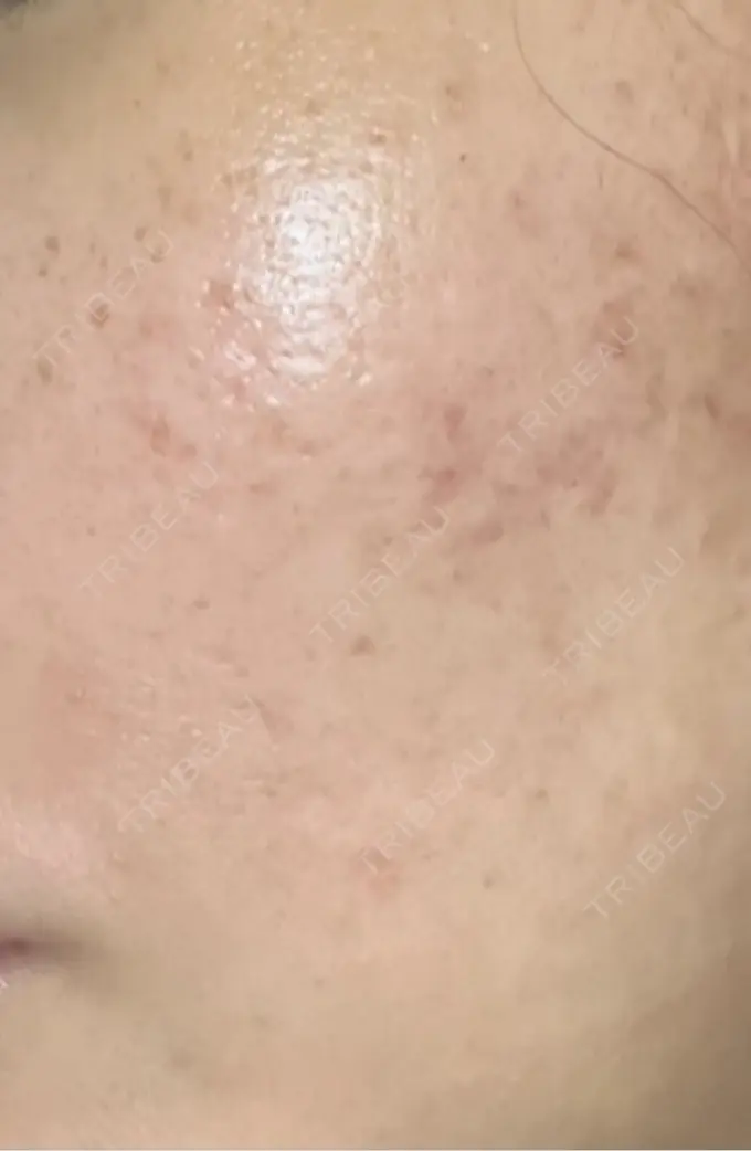 サブシジョン / ニキビ治療 ライブリークリニック 浜松町院 BEFORE メイン用