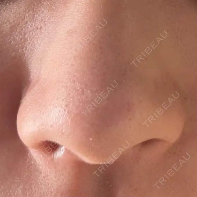 小鼻縮小（切開） GLANZ CLINIC BEFORE メイン用