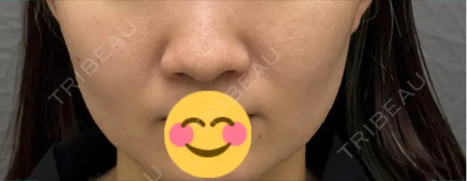 小鼻縮小（切開） 渋谷の森クリニック BEFORE メイン用