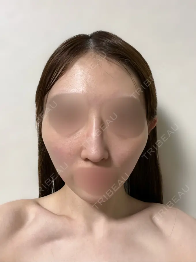 鼻中隔延長（切開） / 骨切り（あご） / 骨削り（エラ） / 骨削り（頬） / 脂肪吸引（脚） / 豊胸（シリコンバッグ） / ワシ鼻修正・ハンプ切除 / 斜鼻修正 / 脂肪注入（額） / その他（肌） / その他（鼻） id（アイディ）美容外科 BEFORE メイン用