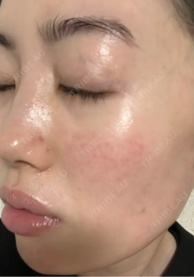 イオン導入 / 光治療（フォトフェイシャルなど） / ピーリング（ハリ・ツヤ） メディアージュクリニック 青山院 BEFORE メイン用