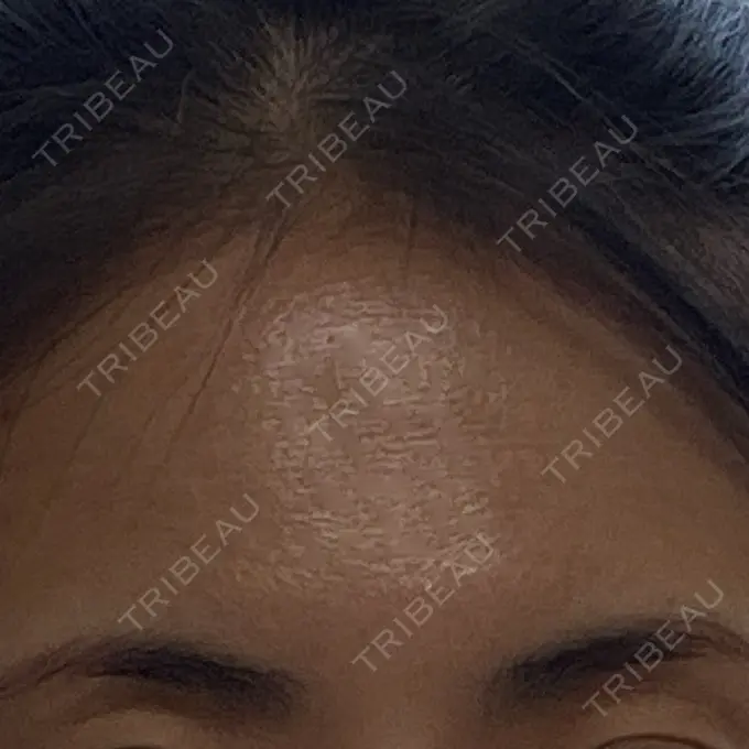 ボトックス（眉間） / ボトックス（額） eクリニック 横浜みなとみらい院 BEFORE メイン用