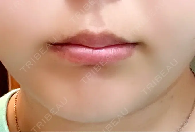 ボトックス（あご） / ヒアルロン酸注入（唇） / ボトックス（口角） / その他（輪郭） ルラ美容クリニック 大阪心斎橋院 BEFORE メイン用