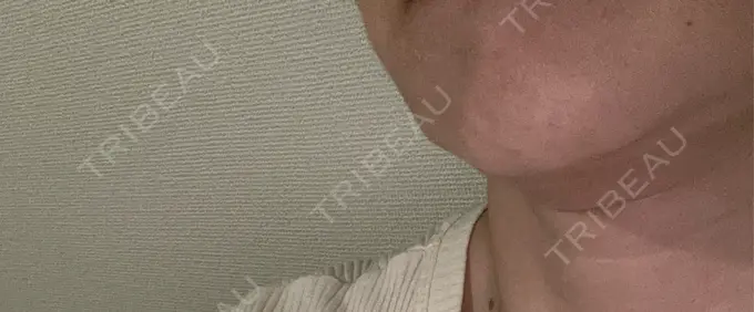 シワ取りボトックス AB美容クリニック 新宿院 BEFORE メイン用