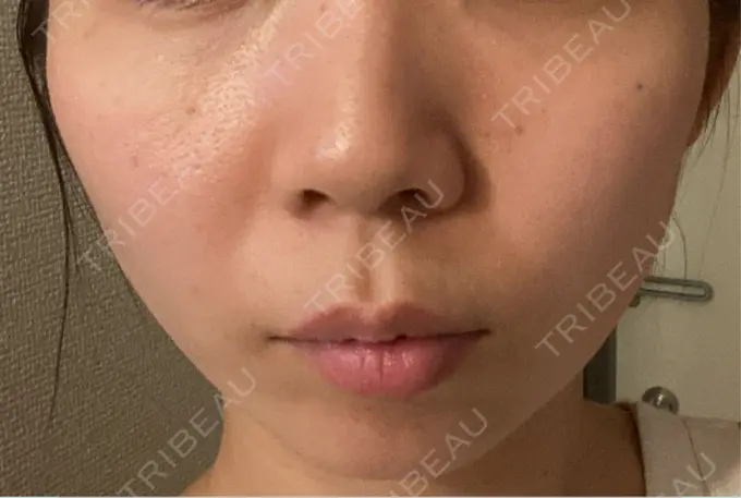 ピコレーザートーニング（美白・肝斑） / ピコスポット APスキンクリニック銀座 BEFORE メイン用