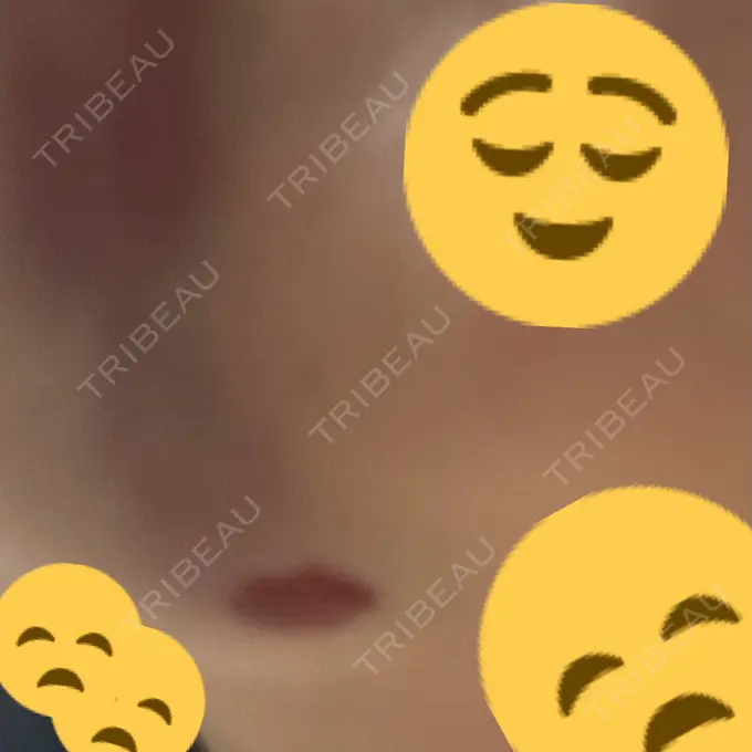 糸リフト / 脂肪吸引（顔） / ジョールファット除去 / 脂肪吸引注射（顔） ziz CLINIC BEFORE メイン用